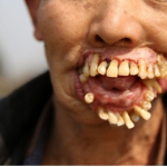 Sởn gai óc với căn bệnh U răng kì dị hiếm gặp tại Việt Nam