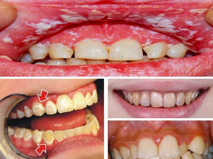 Tẩy trắng răng nhiều lần sẽ làm men răng tổn thương, gây viêm nướu