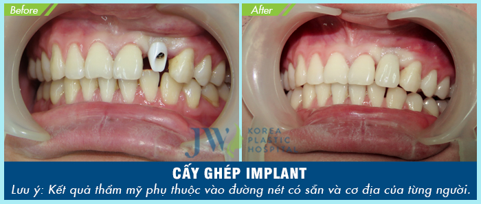Cấy ghép implant với khách hàng mất 1 răng trên cung hàm