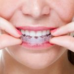 Làm thế nào để thực hiện tẩy trắng răng bằng máng an toàn?