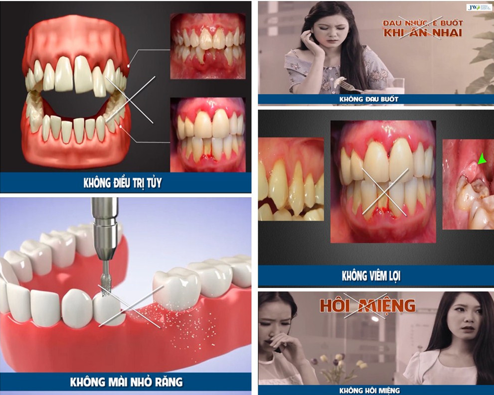 Ưu điểm của bọc răng sứ bằng công nghệ Porcelain Nano 5S