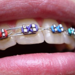 Niềng răng mắc cài kim loại – Giải pháp tối ưu khắc phục khuyết điểm về răng