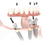 Cấy ghép implant All on 4, on all 6 phục hình hiệu quả hàm răng bị mất