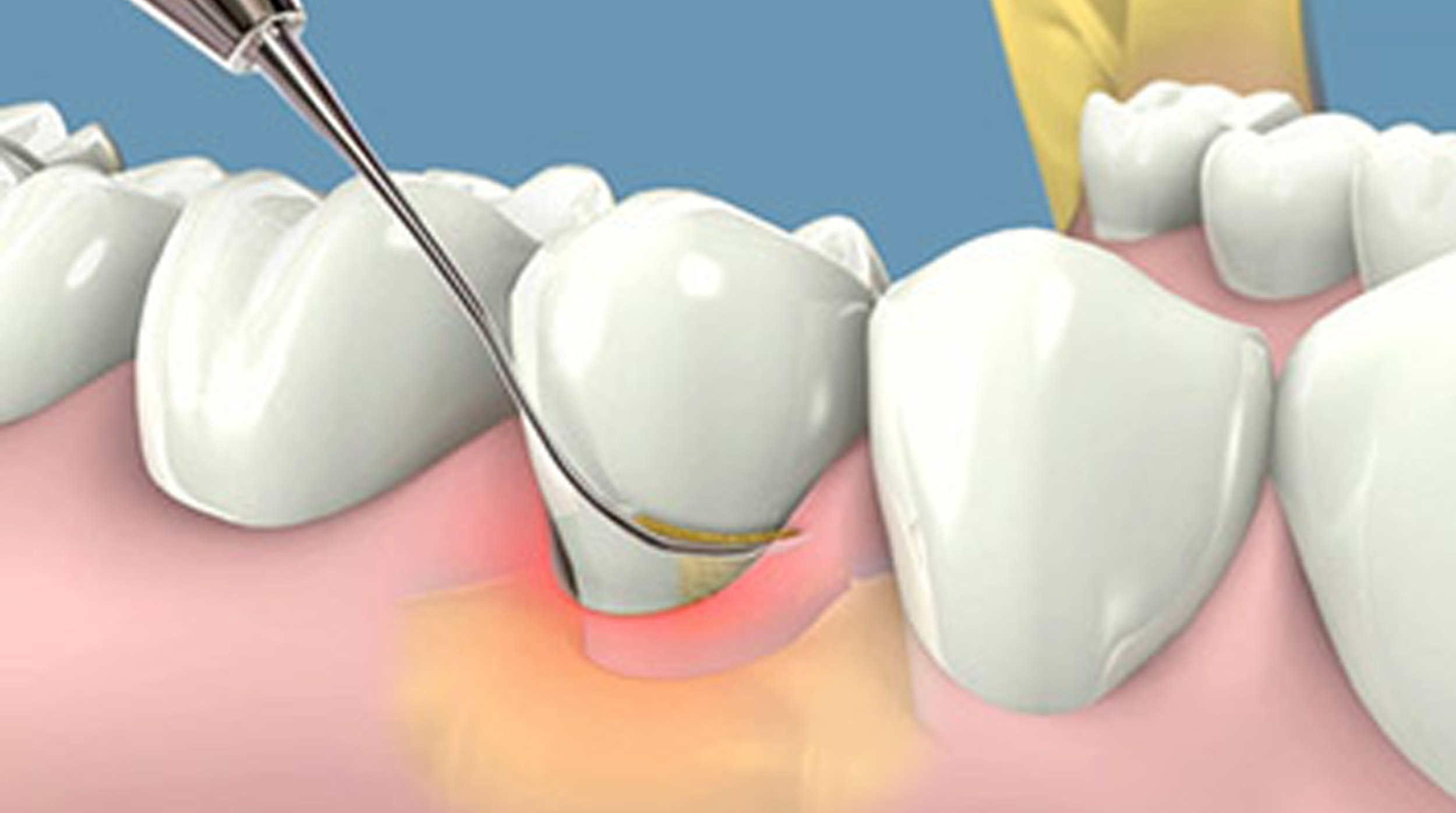 Thực hiện lấy cao răng bằng máy siêu âm hiện đại, chất lượng đem đến vượt xa kỹ thuật lấy cao răng trước đây