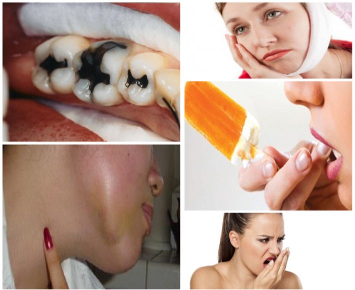 Những dấu hiệu bất thường cảnh báo bạn có thể đang bị sâu răng tấn công