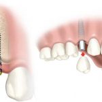 Trồng răng implant mất bao lâu thời gian