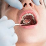 Niềng răng mặt trong – Giải pháp toàn diện cho khuôn hàm sai lệch