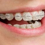 Niềng Răng Móm Không Phẫu Thuật Hiệu Quả An Toàn