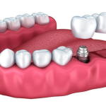 Cấy ghép Implant 5D – Đột phá mới cho phục hình răng hiện đại