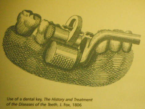Tranh minh họa "chìa khóa răng" vào đầu thế kỉ 19