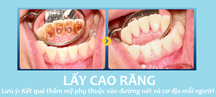 Hình ảnh khách hàng trước và sau khi lấy cao răng tại JW