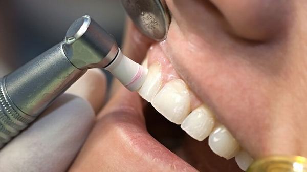 Đánh bóng răng sau khi lấy cao răng  tùy thuộc vào tình trạng của răng và nướu