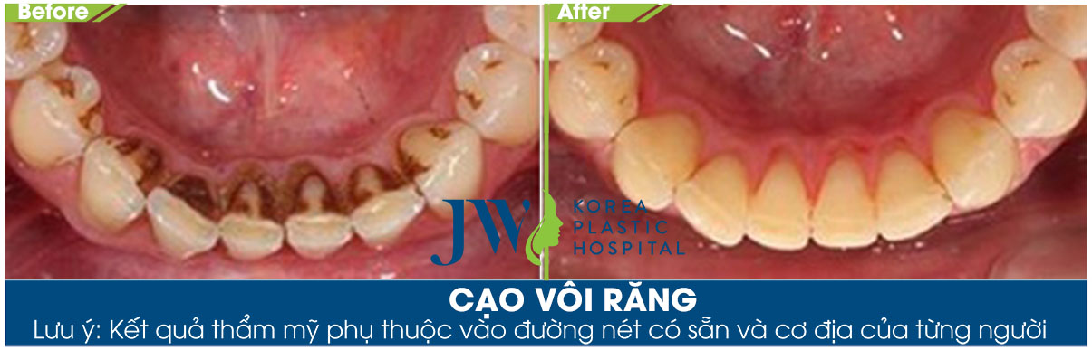 Hình ảnh hàm răng của khách hàng sạch mảng bám sau khi lấy cao răng tại JW