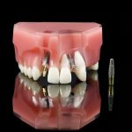 Giải đáp những thắc mắc về trồng răng Implant webtretho