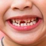Sâu răng sữa ở trẻ em có nguy hiểm gì không?