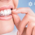 Niềng răng Invisalign và những ưu điểm vượt trội mà nó mang lại