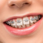 Hô móm nên niềng răng hay phẫu thuật – Chuyên gia giải đáp