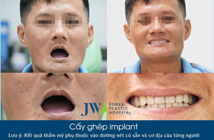 Hình ảnh Cấy ghép Implant toàn hàm