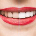 Có nên tẩy trắng răng webtretho không?