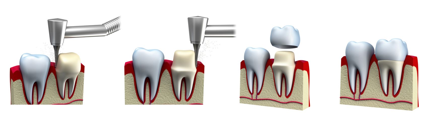 Bọc răng sứ cần phải mài răng để tạo cùi từ răng thật