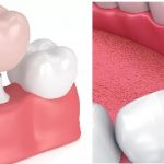 Đâu là điểm khác biệt giữa bọc răng sứ và mặt dán sứ veneer không mài răng?