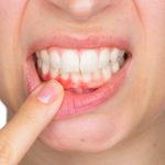 Sưng nướu răng? Nguyên nhân và cách điều trị