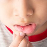 Những mẹo chữa nhiệt miệng đơn giản cho bé phụ huynh cần biết