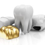 Thời điểm bọc sứ cho răng đã lấy tủy lúc nào là phù hợp và hiệu quả nhất?