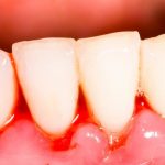 Chảy máu nướu răng – Không nên xem thường