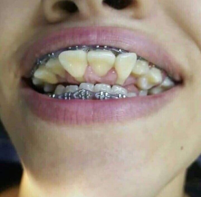 Hình ảnh biến chứng khi niềng răng