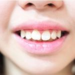Răng hô môi dày phải làm sao để khắc phục và trở nên xinh đẹp toàn diện