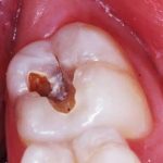 Các bước điều trị tủy răng bạn nên biết