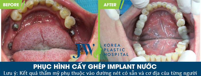 Phục hình cấy ghép implant nước