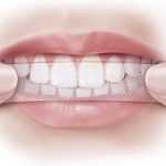 Cách sử dụng miếng dán trắng răng an toàn và hiệu quả