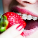 Kiêng ăn gì khi niềng răng để đảm bảo hiệu quả điều trị
