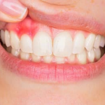 [ TƯ VẤN ] Bị sưng nướu răng trong cùng phải làm sao?