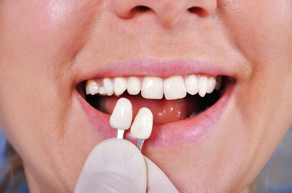 Trồng răng khểnh không đau nhức