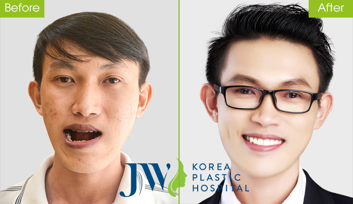 Thạc sĩ xe ôm Duy Phương - Niềng răng kế hợp phẫu thuật hàm