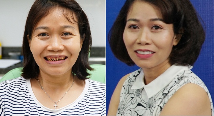 Mài 28 chiếc răng chỉ vì... "Hạt ổi"