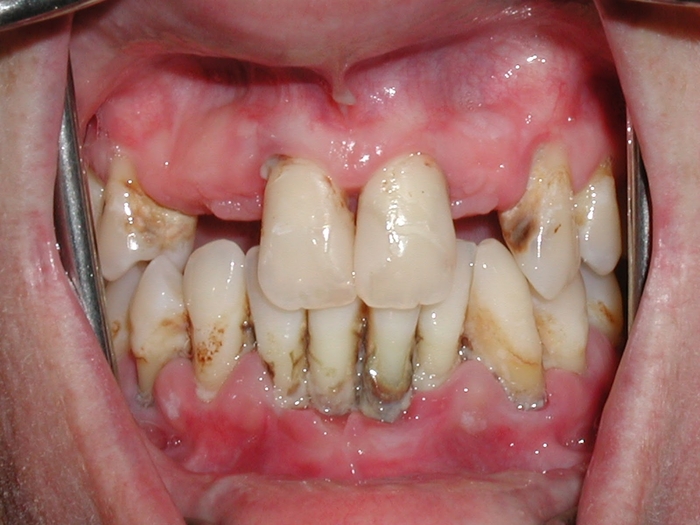 Bệnh viêm nha chu tưởng đơn giản nhưng đã khiến Tiểu Minh phải nhổ hết cả hàm răng trên của mình