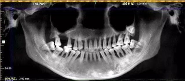 Hình ảnh phim chụp X-quang cho thấy rất rõ hàm răng lỏng lẻo của Tiểu Minh