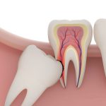 Nhổ răng sâu có nguy hiểm không đối với răng số 8