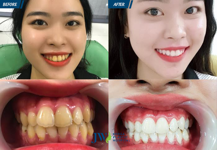 Hình ảnh khách hàng sử dụng công nghệ Tẩy trắng răng Led Bleaching