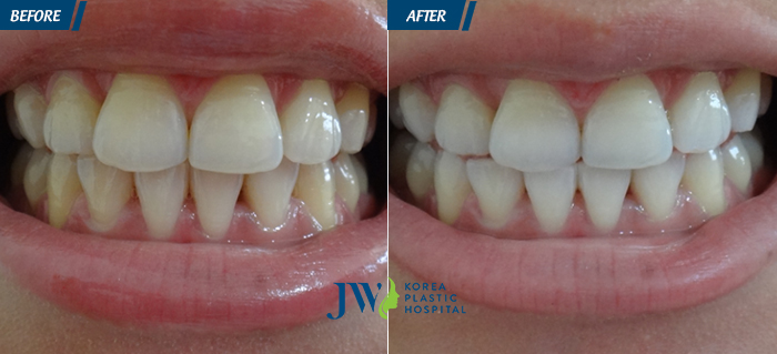 Hình ảnh Khách hàng Tẩy trắng răng tại JW