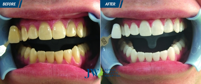 Hình ảnh Khách hàng Tẩy trắng răng tại JW