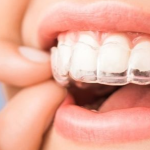 Công nghệ Niềng răng Invisalign – Tự tin với nụ cười tỏa sáng