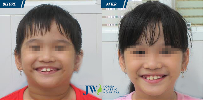 Hình ảnh trước và sau khi niềng răng tại JW Hàn Quốc