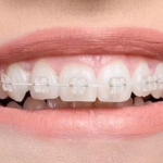 Niềng răng mắc cài sứ có những ưu điểm nào?
