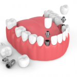 Cấy Ghép Implant Kỹ Thuật Số – Răng Đẹp Thời 4.0