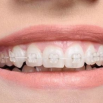 Niềng răng kỹ thuật số phương pháp chỉnh nha tối ưu nhất hiện nay